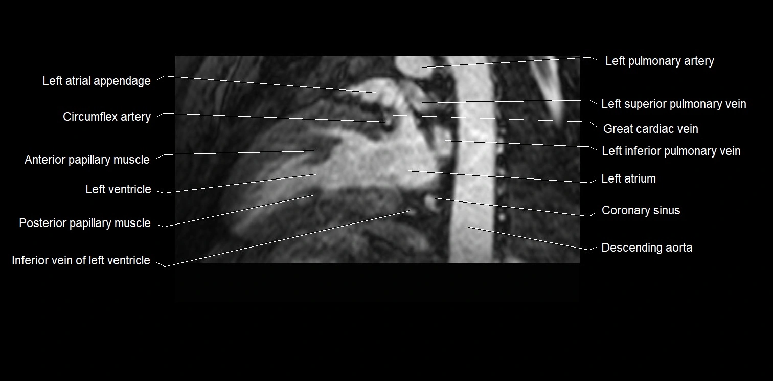 MRI heart and coronary arteries two chamber(sagittal)  anatomy image 31.webp